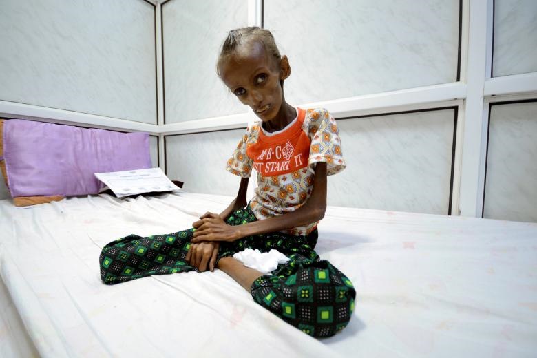 تصاویر دلخراش از کودکان یمنی گرفتار در «بزرگترین بحران قحطی جهان»